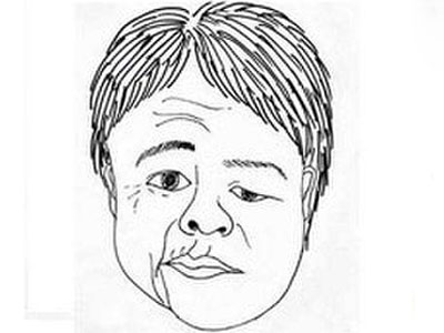 冬季寒风来袭，小心吹“歪”脸 - 血管微语-血管微语