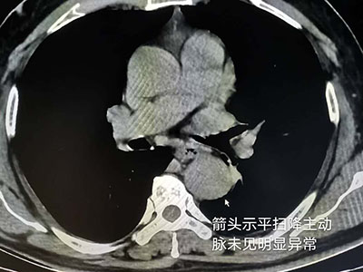 CT检查中的“意外”发现 - 血管微语-血管微语