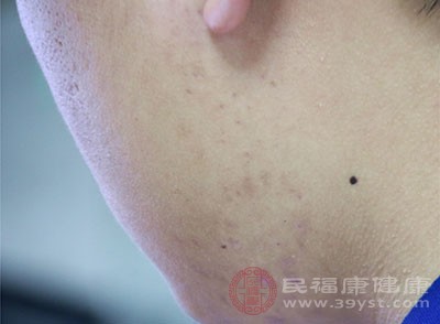 如果你体内湿气重 这3种食物就别贪吃了 - 血管微语-血管微语