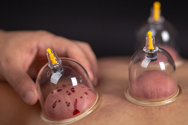 拔火罐的好处-血管微语